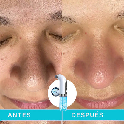 Limpiador de poros - MICRO BUBBLE PRO | Elimina puntos negros y espinillas
